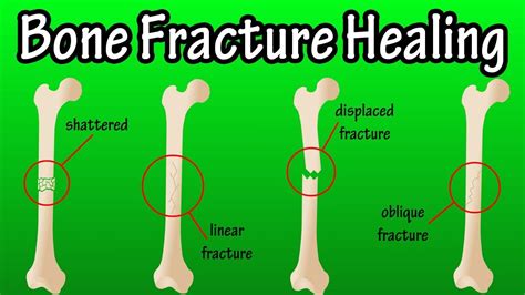 fracturestime
