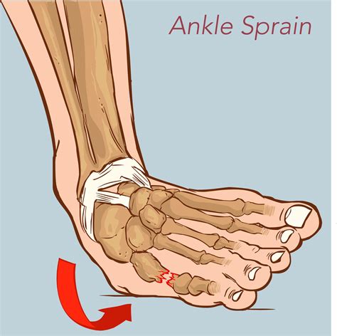 no sprained ankle