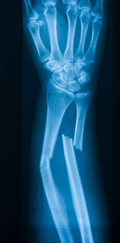 traumatic fractures
